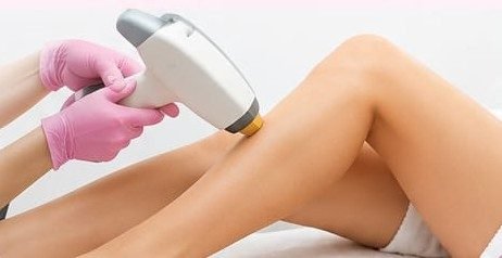 Laser Hair Removal